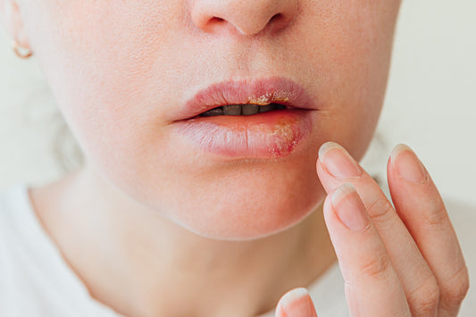 Herpes / Cold Sores